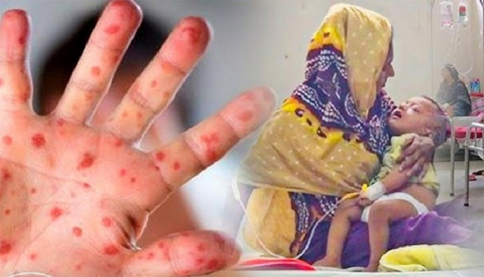 দেশে হাম ও উপসর্গে আরও ৫ শিশুর মৃত্যু